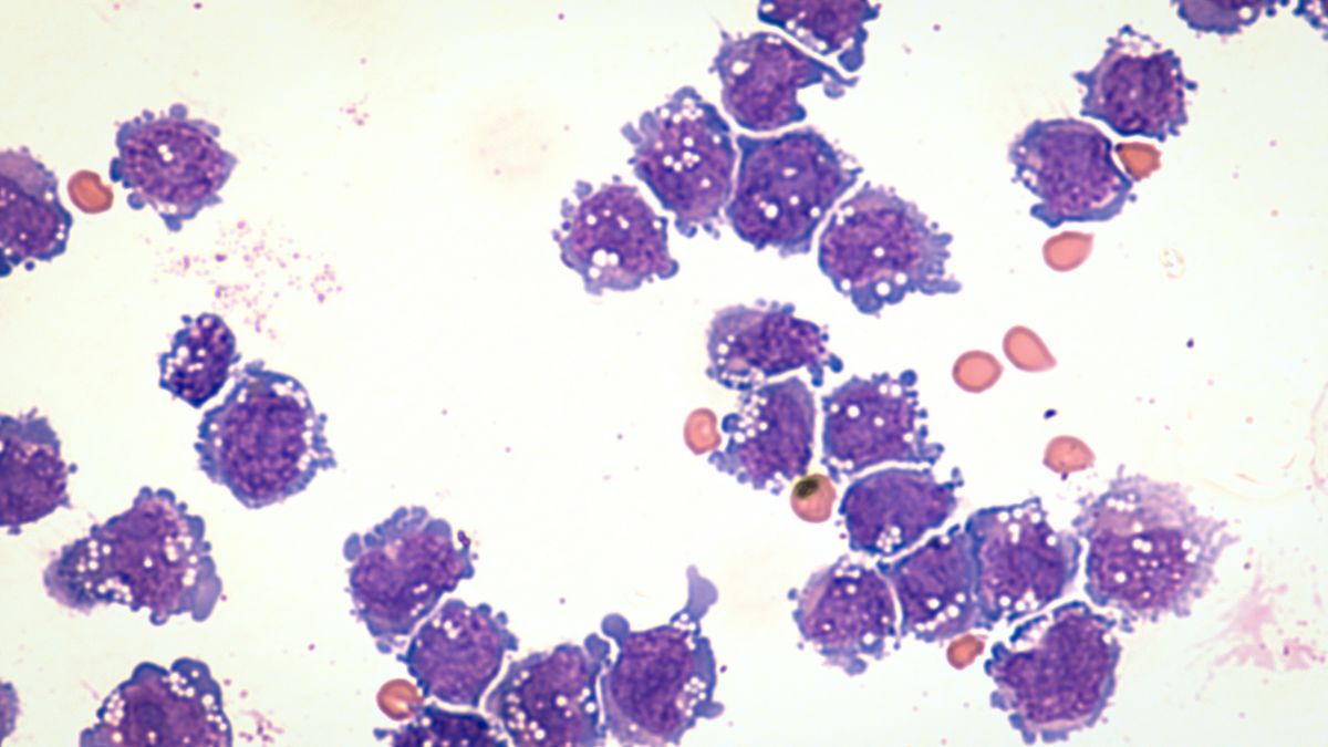 Limfocytowe śródmiąższowe zapalenie płuc (LIP)