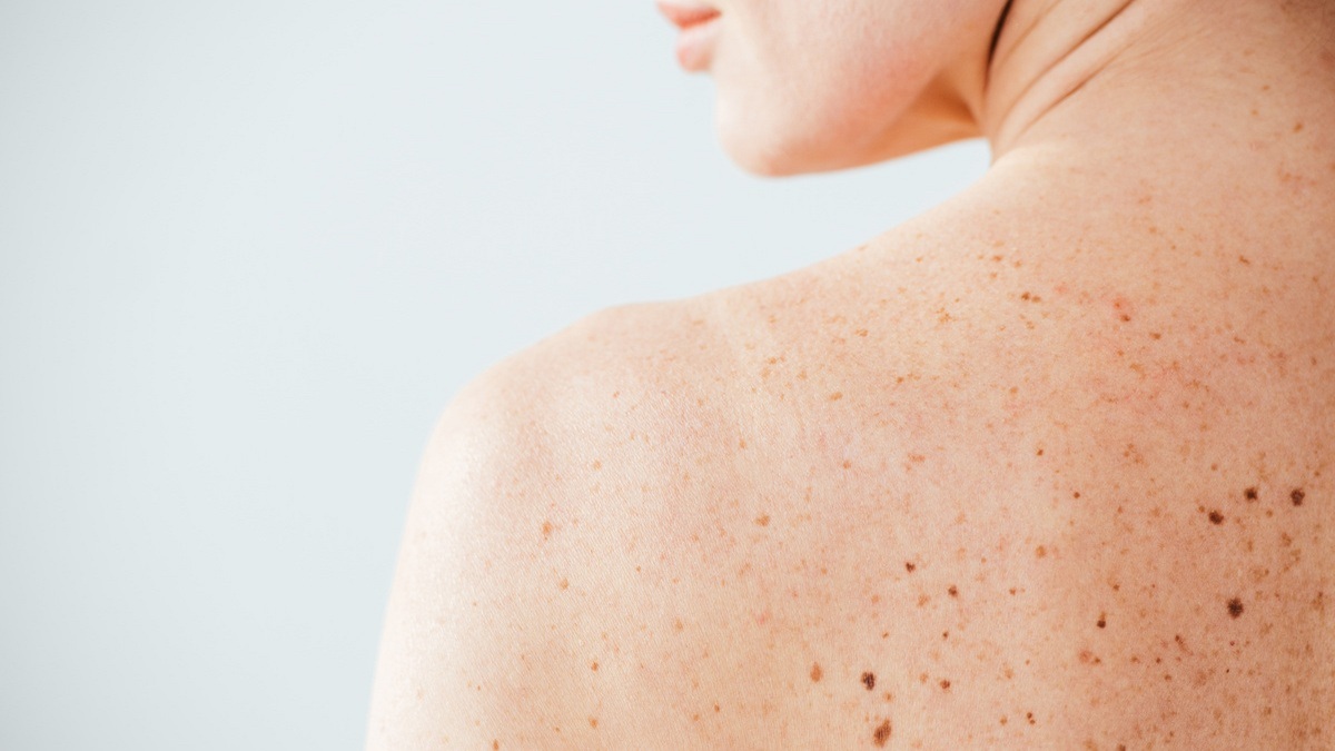 Jak poprawić jakość życia polskich pacjentów z mastocytozą indolentną?